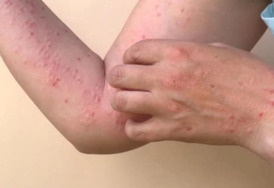Barranquilla intensifica vigilancia epidemiológica ante casos de viruela símica