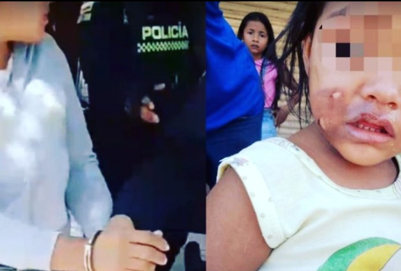 Madre quema a su hija de cuatro años con una cuchara caliente